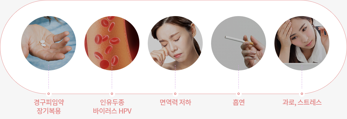 자궁경부이형성증 원인 — HPV 인유두종바이러스 감염으로인한 면역력 저하,스트레스·다이어트·수면부족 원인도식