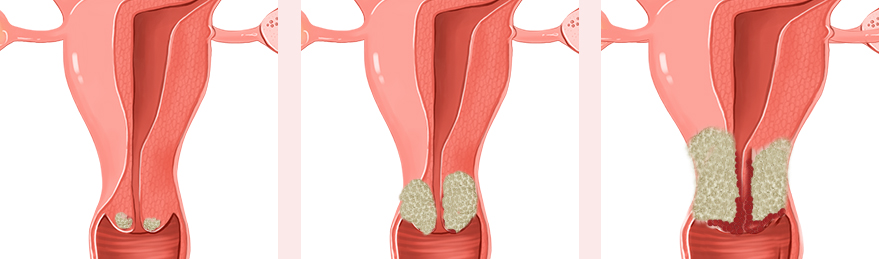 자궁경부이형성증 Grade1·2·3 단계별 이형세포침범 정도 분류 도식 — 단계에따른 치료 방향 안내