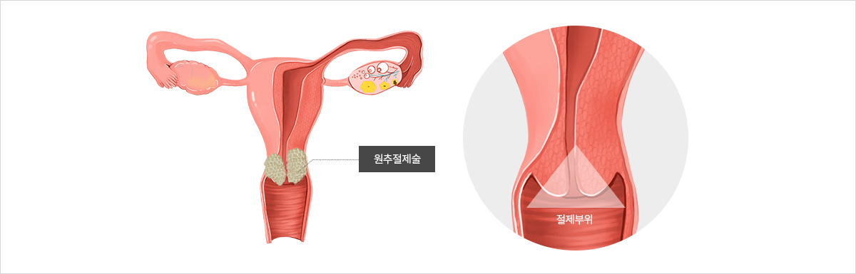 자궁경부이형성증 원추절제술 부작용 — 재발가능성, 자궁경부 길이 단축으로인한 조산·유산 위험 설명 도식