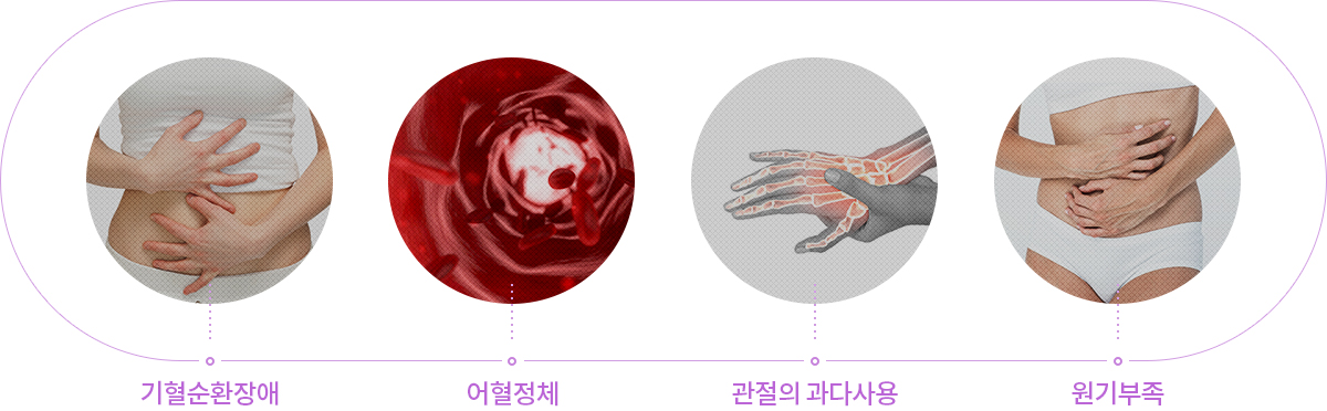 산후풍 발생 원인 — 출산 후기혈 허약, 어혈 정체, 찬 기운노출로 인한 산후풍 발생메커니즘 도식