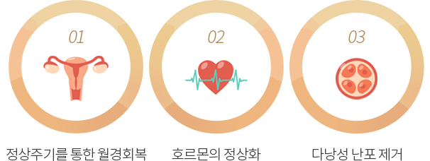 인애한의원 다낭성난소증후군 한방치료 효과 — 정상주기 월경회복·호르몬정상화·다낭성 난포 제거 도식