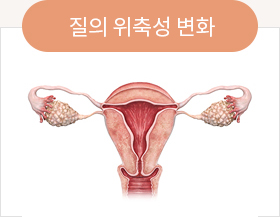 질의 위축성 변화