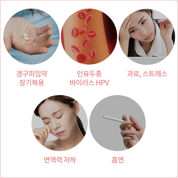 자궁경부이형성증 원인 — HPV 인유두종바이러스 감염으로인한 면역력 저하,스트레스·다이어트·수면부족 원인도식