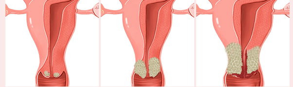 자궁경부이형성증 Grade1·2·3 단계별 이형세포침범 정도 분류 도식 — 단계에따른 치료 방향 안내