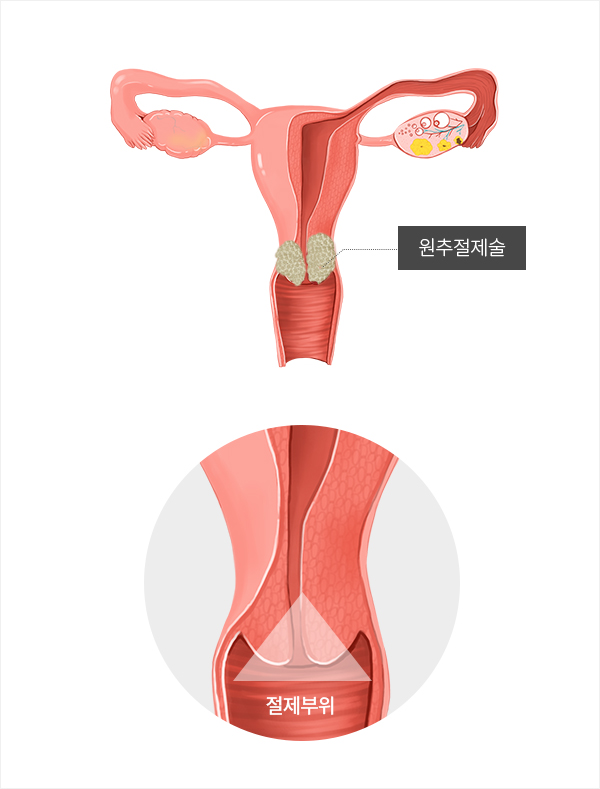 자궁경부이형성증 원추절제술 부작용 — 재발가능성, 자궁경부 길이 단축으로인한 조산·유산 위험 설명 도식