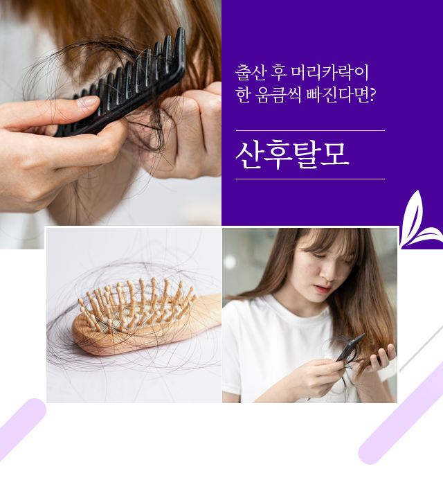 산후탈모